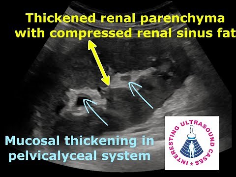 PYELONEPHRITIS ON ULTRASOUND || 4 Different Cases || Emphysematous pyelonephritis