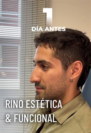 Rinoplastía: Más que un Cambio Estético, una Experiencia