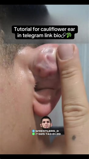 Tutorial for Managing Cauliflower Ear Effectively
