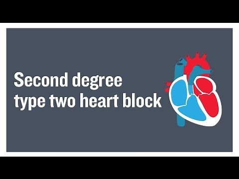 Second degree type two heart block