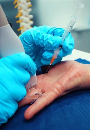 How to relieve trigger finger syndrome? Trigger finger happens when the tendon that bends your finger becomes irritated and swollen. The space it moves through gets tight, so the finger may click, catch, or lock when you try to straighten it. A trigger finger injection reduces inflammation around that tendon sheath. When swelling decreases, the tendon can glide more smoothly again. Movement improves and the finger can bend and extend without that painful catching. #painmanagement #health #recove