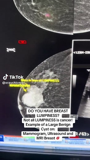 Understanding Breast Cysts: What You Need to Know