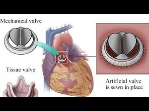 "Foldax Tria Mitral valve Study//Don't miss