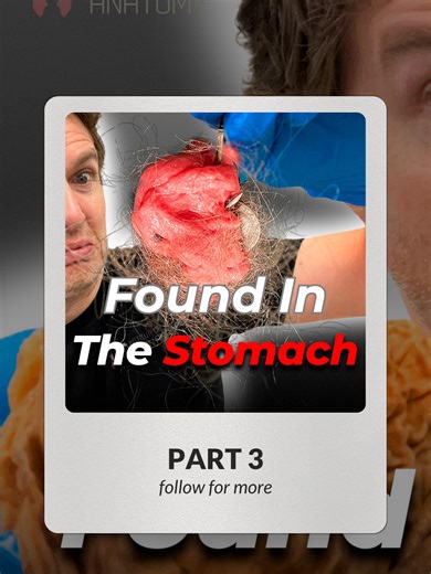 What People Swallow: Part 3 - The DANGEROUS Stuff 🚨⚡ Time to cover the items that require immediate medical intervention—these are NO JOKE! Most swallowed items pass harmlessly, but batteries, multiple magnets, and sharp/large objects require immediate medical attention! When in doubt, get checked out! 🏥 That's our list! Hopefully you learned some crazy useful info! 🤯 #foreignbodyingestion #batteries #magnets #swallowing #medicalemergency #esophagus #endoscopy #humananatomy #digestivesystem #