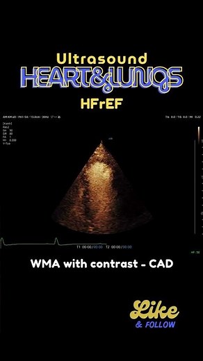 #WMA in #echocardiography - with #contrast in #ceus