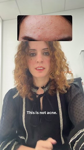 Acne is a common skin condition characterized by spots, oily skin, and sometimes painful lumps, occurring when hair follicles become blocked by oil and dead skin cells. Acne can be misdiagnosed with other conditions like peri-oral dermatitis , inflammatory rosacea and malassezia folliculitis. #riversideskinandlaserclinic #acne #acnelikeconditions #dermatologist | Riverside Skin & Laser Clinic