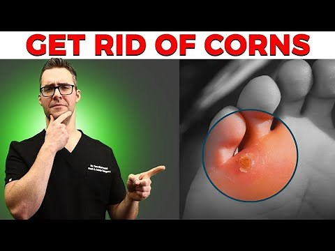 Calluses, Foot Corns & Plantar Wart Removal [Top 10 Home Remedies]