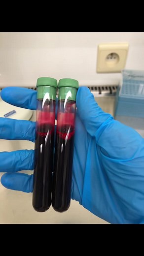 ¿Conocías este tipo de tubo de sangre?? 🩸🩸🩸🧪🥼 Estos son los tubos de sangre BD Vacutainer con heparina de sodio como anticoagulante. Este anticoagulante se encuentra en las paredes del tubo por lo que necesite que se mezcle homogéneamente para evitar coágulos. Tienen muchos usos aplicados a la práctica clínica, pero en mi caso los utilizo principalmente para añadir un reactivo específico que me permite purificar un tipo celular del sistema inmunitario tipo linfocitos T, B o NKs. ———————————