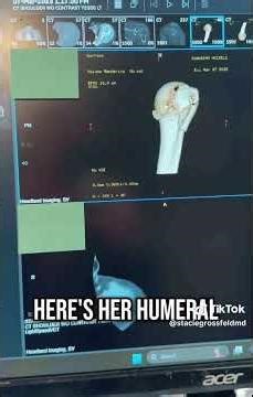 Proximal Humerus Fracture X-Ray VS. 3D CT Scan | Dr. Stacie Grossfeld