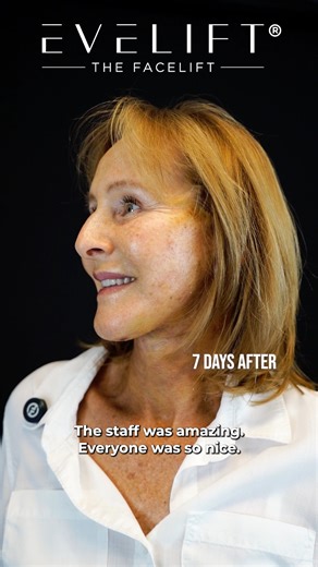 EVELift® on Instagram: "When real patients speak, the truth is undeniable — this is the power of the EVELift® facelift and necklift. “I highly recommend that you don’t just follow — you come in, you see it, you get it done.” - Natalia “The nurses were so nice, they came in to see me every day in my room.” Catherine “Minimal pain — Tylenol only. Very little discomfort.” Dana “Here I am just a few days out, and you can already see how amazing his work is.” Debra Your transformation starts here — D