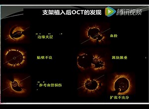 【微课堂】IVUS_OCT-指导PCI及支架随访
