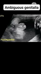 Ambiguous genitalia #fetalscans #pregnancy #radiology #ultrasound #genital | Radiology Interesting