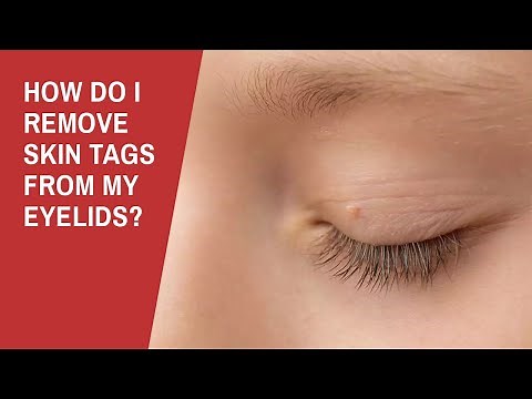 How Do I Remove Skin Tags from My Eyelids?