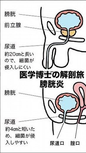医学博士の解剖旅315-317膀胱炎膀胱は尿をためる場所なので、細菌が入りやすく、膀胱炎（ぼうこうえん）という病気が起こる。#解剖学#ダイエット#病気#膀胱