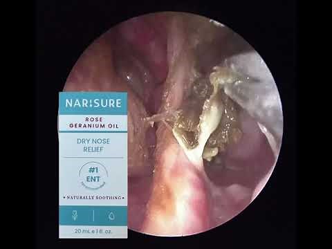 Enormous green crust removal