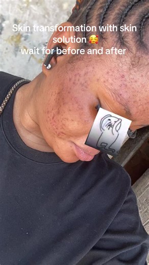 Your skin solution🇳🇬🇬🇭🇬🇧 (@your_skin_solution)’s videos with POE - Ruger & Bnxn