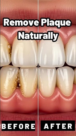 Remove Dental Plaque Naturally with This Proven Ancient Remedy