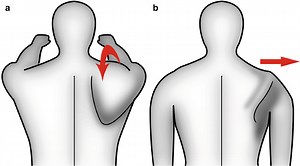 Discinesia Scapolare: è davvero un problema? - FisioScience