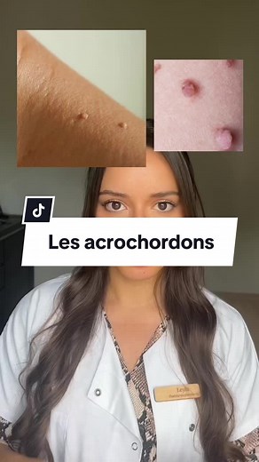 Les acrochordons : causes et solutions