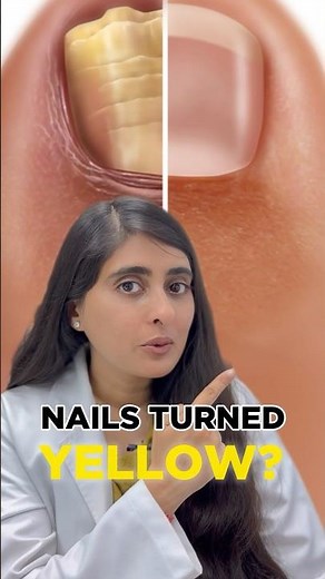 Nail Fungal Infection Treatment | How to get rid of toenail fungus | Nail Fungal infection