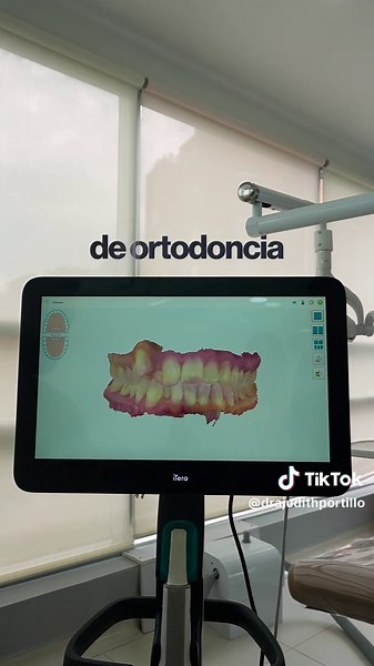 Te explicamos un caso de ortodoncia invisible que acabamos de escanear 🦷✨ Con el escáner digital podemos ver con precisión cómo están tus dientes y planificar todo el tratamiento antes de empezar. Así sabemos cómo se moverán y cuál será el resultado final de tu sonrisa 😁 La odontología digital nos permite tratamientos más precisos, cómodos y predecibles. #Volut #OrtodonciaInvisible #DraJudithPortillo #Invisalign #OdontologíaDigital #SonrisaPerfecta