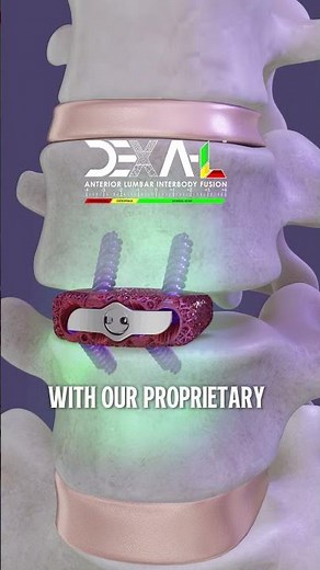 DEXA-L™ — engineered for precision in anterior lumbar fusion.
