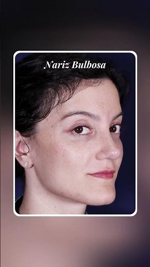 Tipos de narices: casos reales 👉🏻 Antes y Después