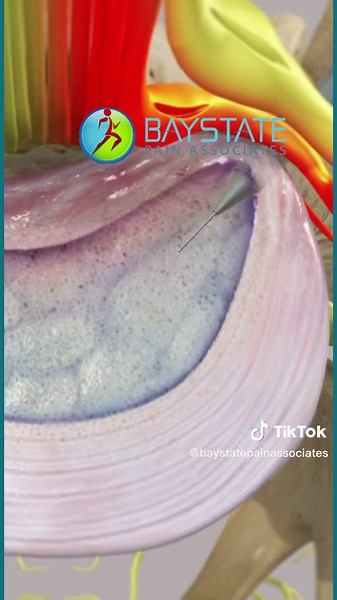 Percutaneous Laser Disc Decompression Explained