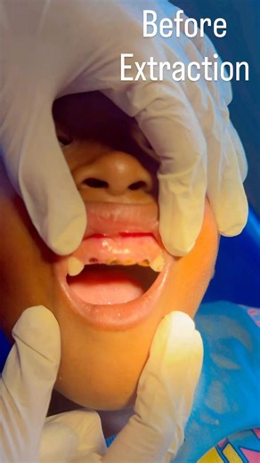Pediatric Extraction Under Local Anesthesia #childtoothextraction #childdentalcare #kidsoralhealth