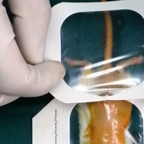 Video: Comparing Metastatic Clear Cell Renal Cell Carcinoma Model Established in Mouse Kidney and on Chicken Chorioallantoic Membrane