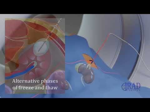 Renal Tumor Ablation (CT guided Cryoablation of kidney Tumor)