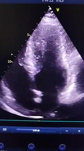 13K views · 57 reactions | Apical H. Cardiomyopathy (ApHCM — a...