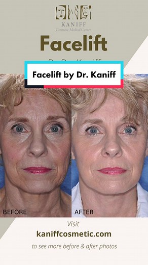Another beautiful Facelift Before & After Photo by Dr. Kaniff 😍 This patient came to us after noticing sagging in the cheeks and neck area. After a consultation with Dr. Kaniff to discuss her concerns, a surgical facelift was performed to rejuvenate, sculpt, and tighten the cheek and neck area. Results: Before and after photos significantly improved her jawline and overall facial profile! After the facelift surgery, the patient is happy with her new refreshed & natural appearance. 👏🏽 Are you