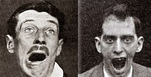 Encephalitis Lethargica: The Strange Disease That Killed 500,000 People, And Then Abruptly Disappeared