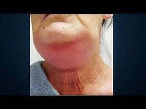 6 BDS Gen Surg Neck Infections