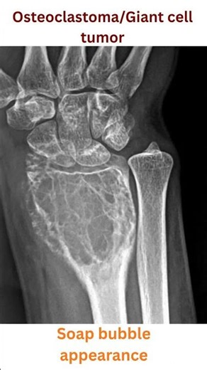 Orthopaedics - Osteoclastoma 🦴 | Giant Cell Tumor of Bone #orthopaedics #orthopedics #bones