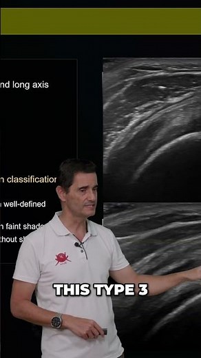 Calcification Removal Prevent Bursa Rupture for Better Health