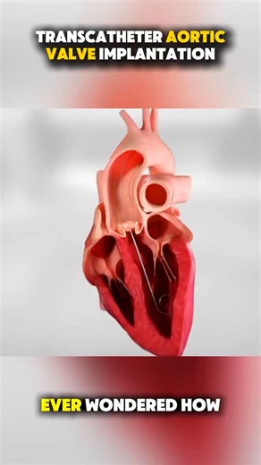 ECG on Instagram: "🫀 TAVI Procedure – Quick Summary ➡️ TAVI (Transcatheter Aortic Valve Implantation) is a minimally invasive treatment for severe aortic stenosis in patients at high or intermediate surgical risk. 🔶 The valve is delivered via catheter (most commonly transfemoral) and deployed inside the native aortic valve. ✅ Improves symptoms, cardiac output, and survival ✅ Shorter recovery time compared to surgical AVR ⚠️ Key risks: vascular complications, stroke, conduction disturbances → p