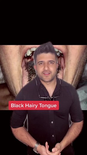 Reply to @squire246 How do you get rid of Black Hairy Tongue? #dentist #nhs doctor #health #healthtips #teethwhitening #tongue #learnontiktok