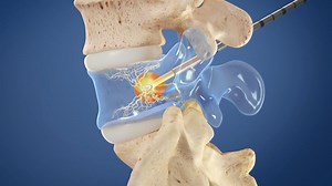 The Intracept Procedure