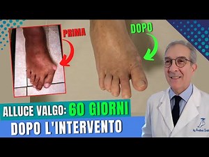 Hallux valgus and hammer toe rehabilitation | Dr. Andrea Scala