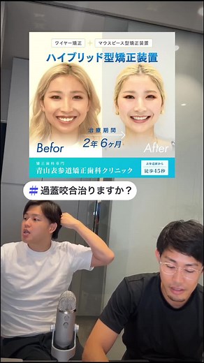 過蓋咬合の治療法とそのメリット