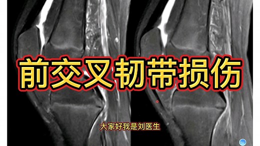 前交叉韧带MRI解剖及损伤影像表现，实用干货，建议收藏！