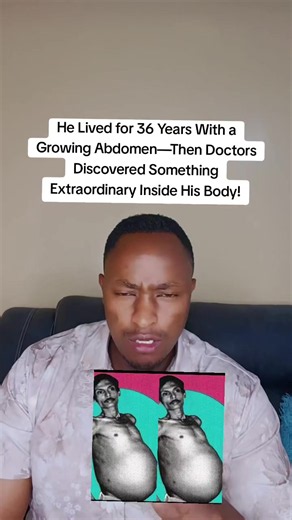 He Lived for 36 Years With a Growing Abdomen—Then Doctors Discovered Something Extraordinary Inside His Body! Imagine living your entire life with an abdomen that keeps growing, only to discover decades later that the cause may be a rare medical condition known as fetus in fetu. According to the story, a baby born in England had an unusually swollen abdomen that continued to enlarge as he grew older. By the age of 36, the swelling had reportedly become so severe that he was experiencing difficul