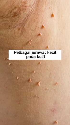 Effective Wart Removal Cream for Skin Blemishes