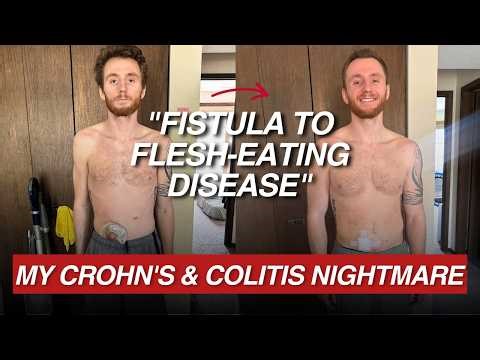 He Was Stuck With a Colectomy Bag… Until This Shift ‪@crohnscolitislifestyle‬