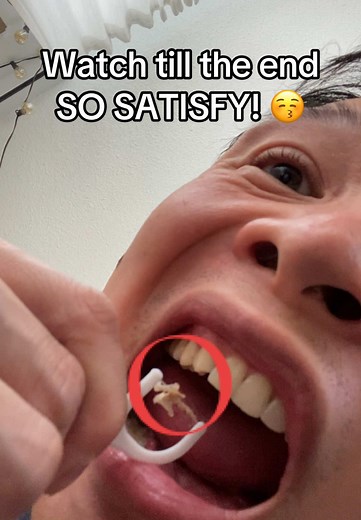 Tonsil stones removal #tonsilstones batu amandel dicabut flossing teeth Removing Tooth #Plaque flossing teeth benefits proper flossing of teeth not flossing your teeth flossing teeth plaque #flossing #floss #asmr #asmrsounds #asmrvideo #asmrtiktoks