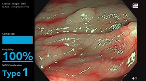 ai4gi Real-time Polyp Differentiation - NICE Type-1 & Type-2