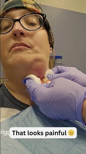 Large Blackheads Extraction Big Cystic Acne Blackheads&Whiteheads Removal Pimple Popping #1074 2026