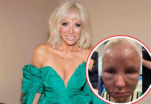 PHOTOS: ‘RHONJ’ Star Margaret Josephs Shows Before & After Pics of CO2 Laser Treatment as She Details "Monstrous" Procedure and Why She Did It, Plus Costars & Dorinda React
